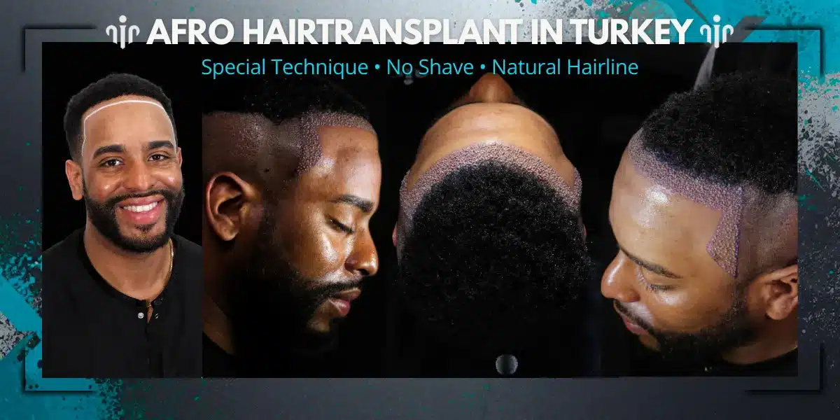 Natural Hairline Is Essential For Achieving Realistic And Aesthetically Balanced Hair Transplant Results.