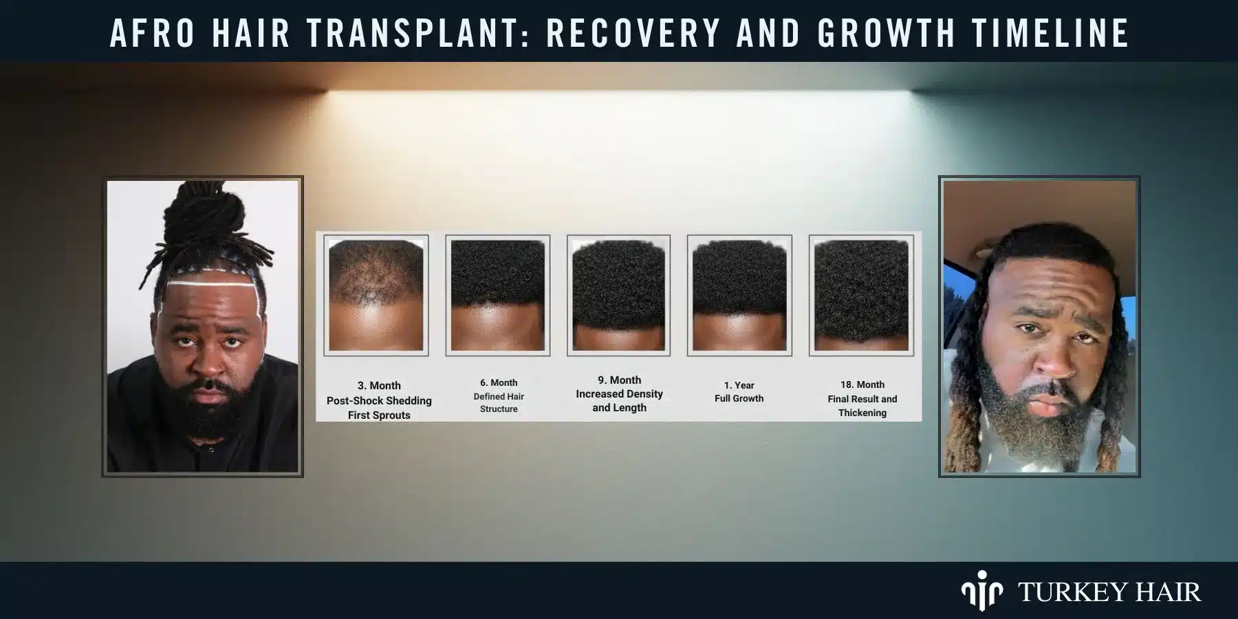 Understand The Recovery Process And Hair Growth Stages After A Hair Transplant For Optimal Results.