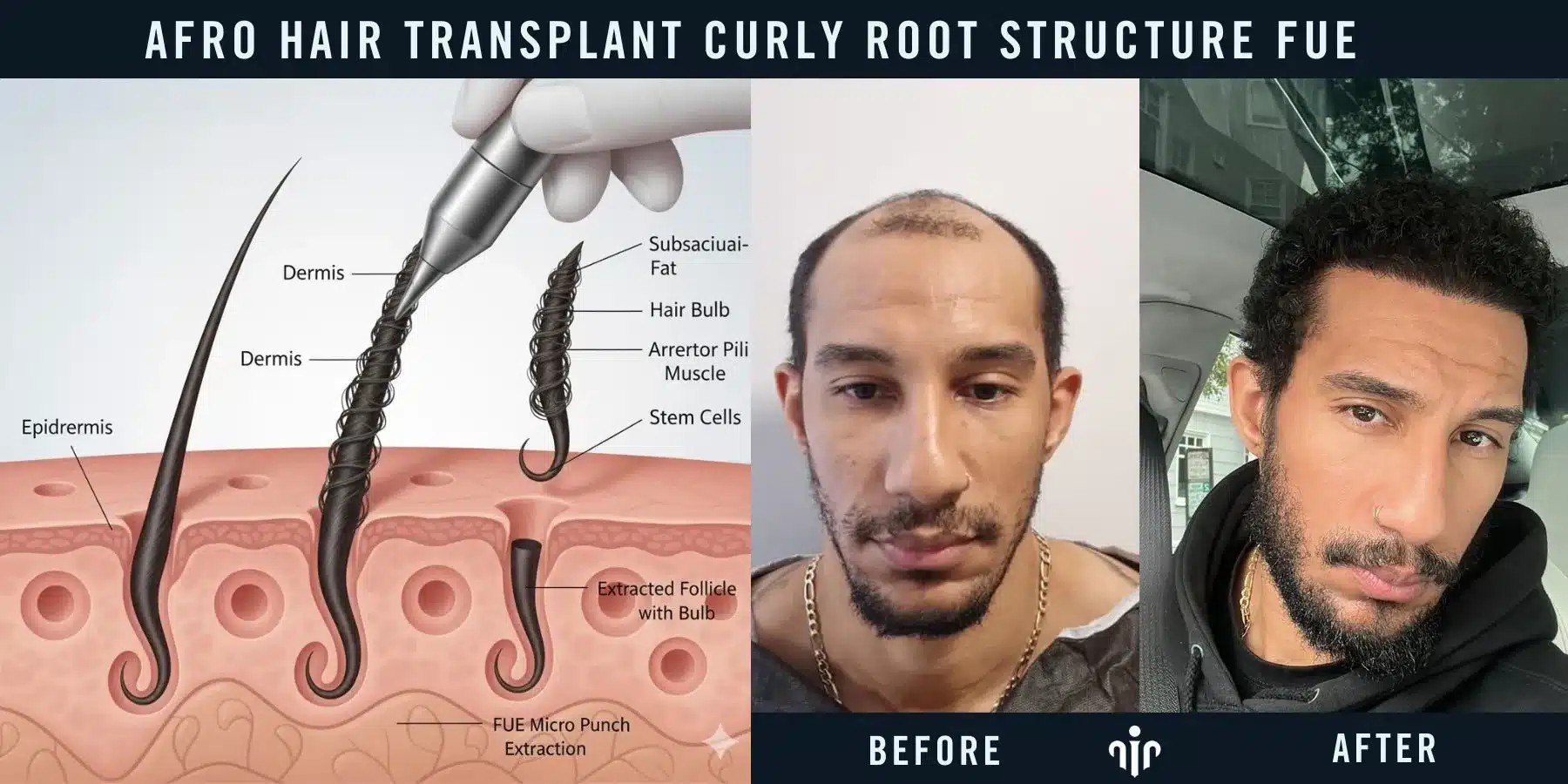 Curly Hair Roots Have A Unique Curved Structure Beneath The Scalp, Requiring Specialized Techniques During Hair Transplantation.
