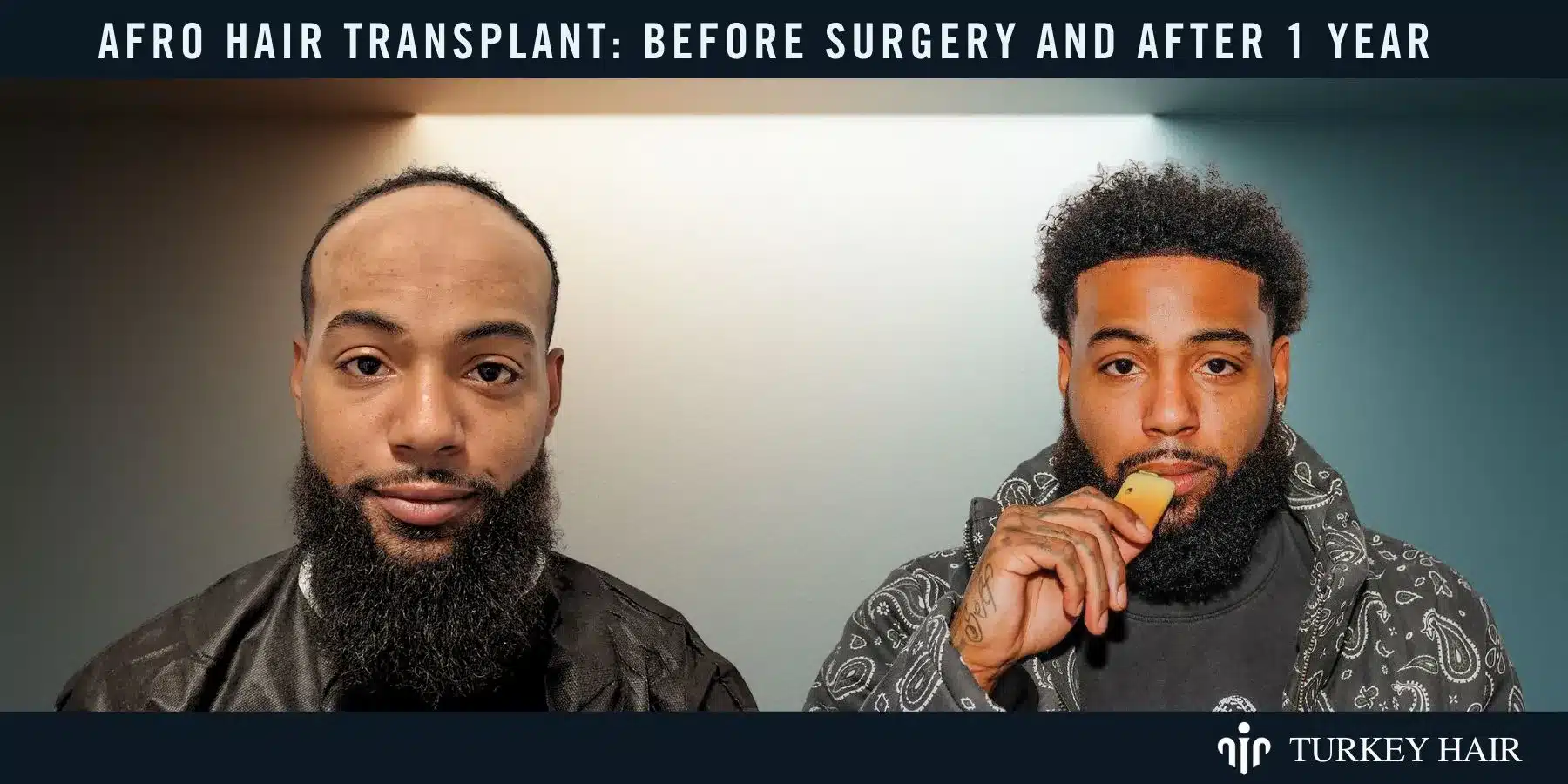 See The Transformation With Before And After Results, Showcasing Natural Hairline And Improved Density.