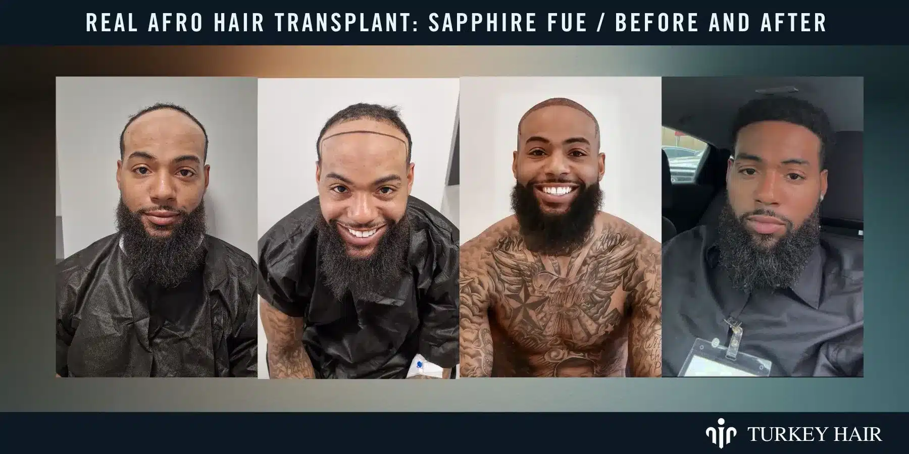 Sapphire Fue Before And After Results Showing Natural Hairline And Improved Density.