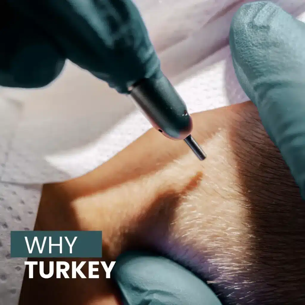 Fue Hair Transplant In Turkey – Cost, Before &Amp; After 8 Discover Why Turkey Is A Top Destination For Hair Transplant Procedures.