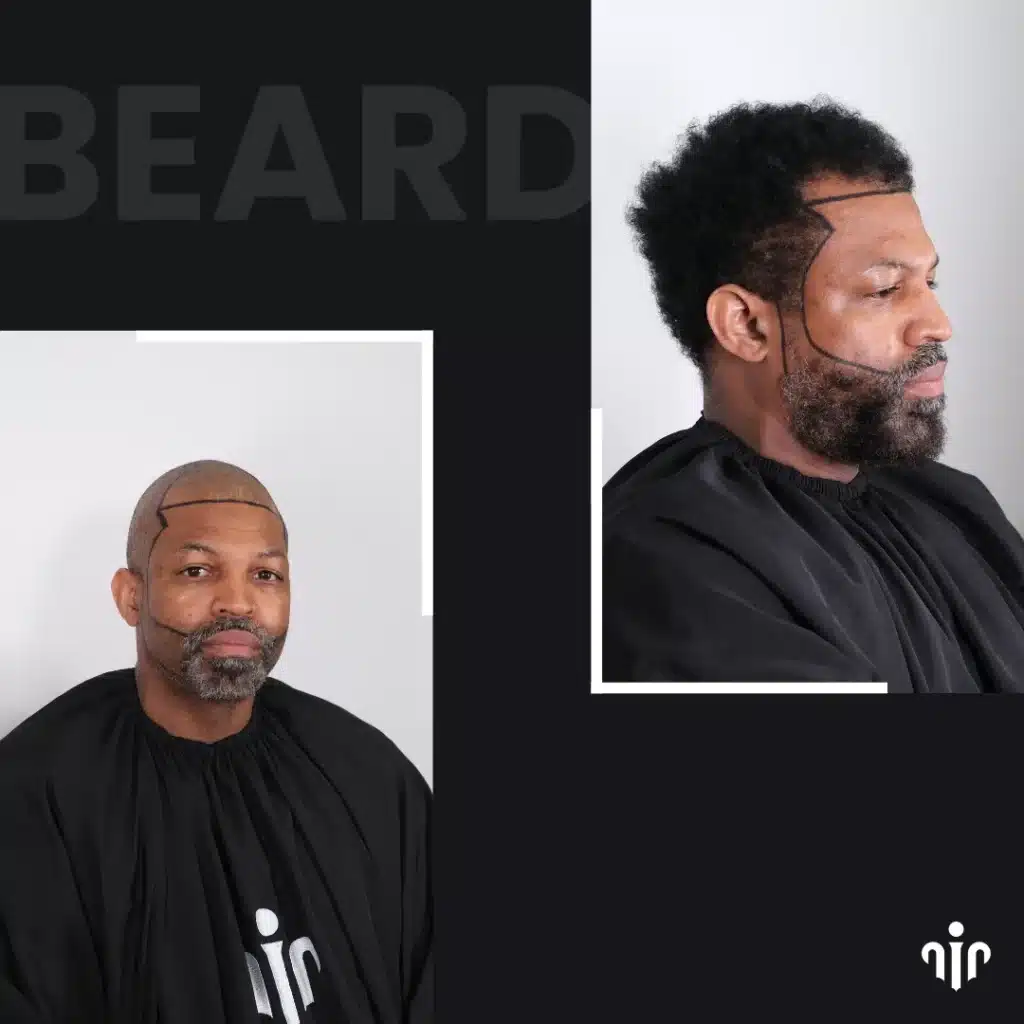 Before Beard Transplant Showing Planned Beard Design Drawn On The Face