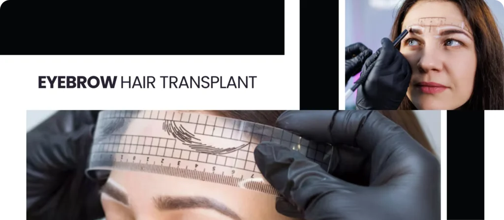 Eyebrow Transplant 