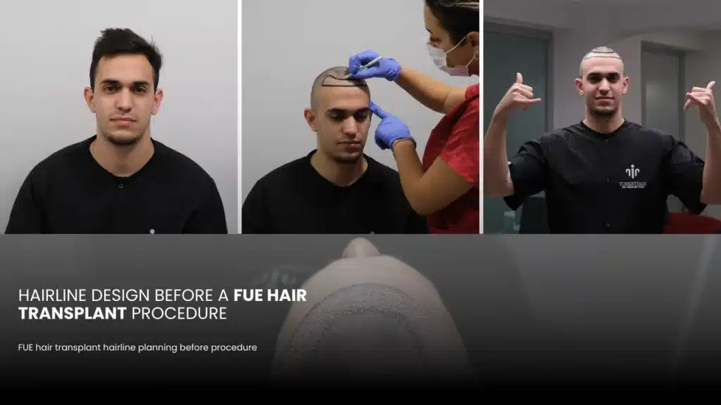 Fue Hair Transplant In Turkey – Cost, Before &Amp; After 13 Hairline Design Is The Key To Achieving Natural And Aesthetically Balanced Hair Transplant Results.
