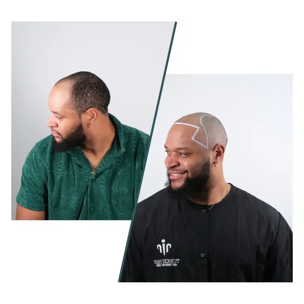 Fue Hair Transplant In Turkey – Cost, Before &Amp; After 14 Before Hair Transplant Showing Planned Hairline Design Drawn On The Scalp