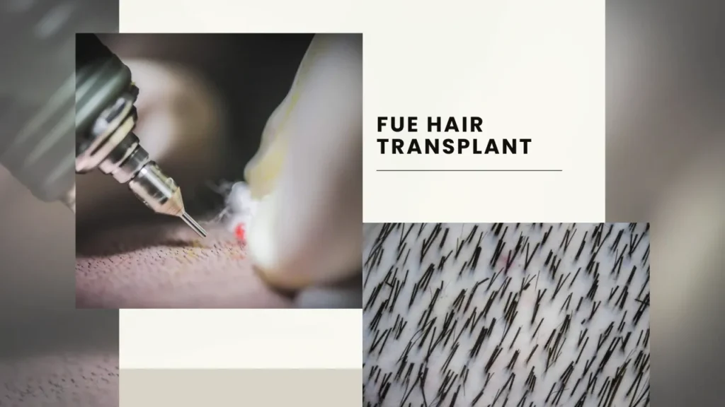 Fue Hair Transplant In Turkey – Cost, Before &Amp; After 10 Fue Hair Transplant Technique Involves Precise Extraction Of Individual Follicles For Natural-Looking Hair Restoration.