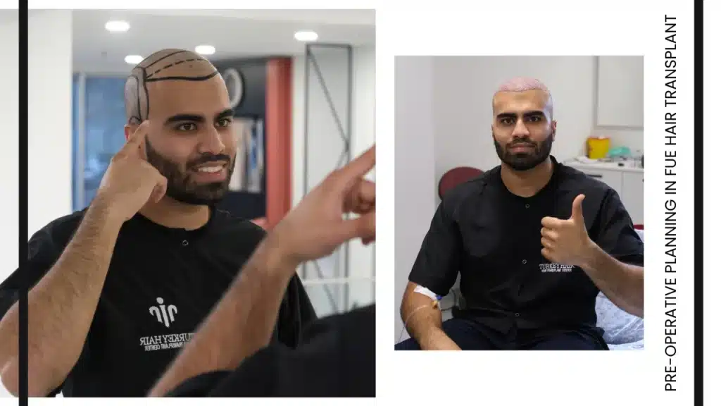 Fue Hair Transplant In Turkey – Cost, Before &Amp; After 16 Operation Planning Is A Crucial Step Where The Procedure Is Carefully Designed Based On The Patient’s Needs, Hair Structure, And Desired Results.