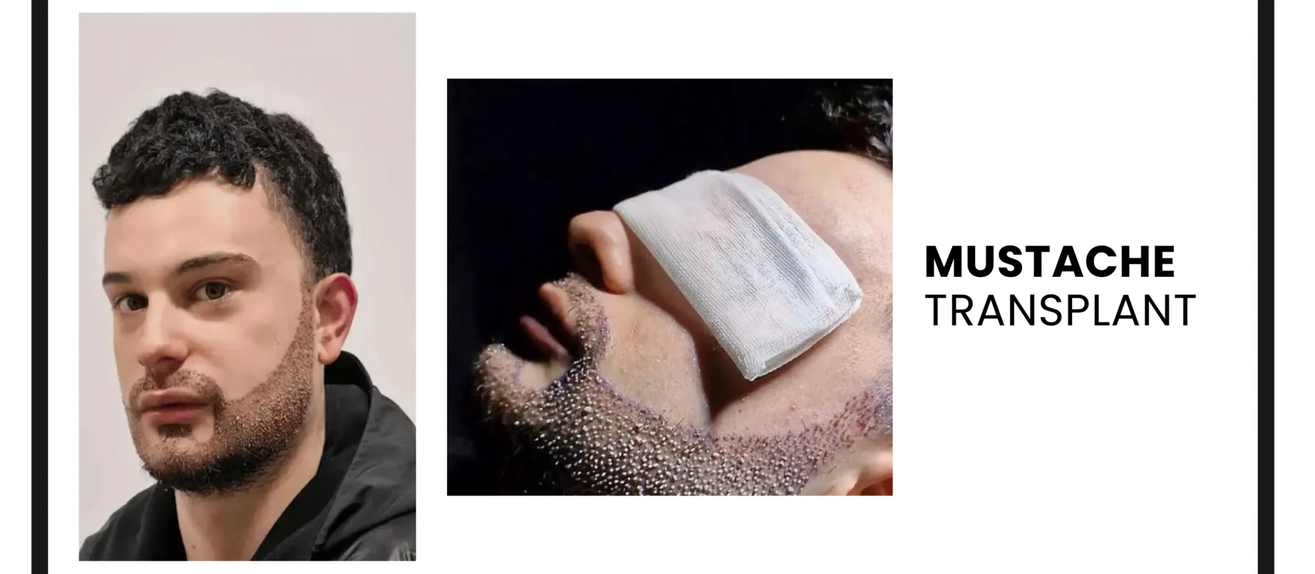 Mustache Transplants