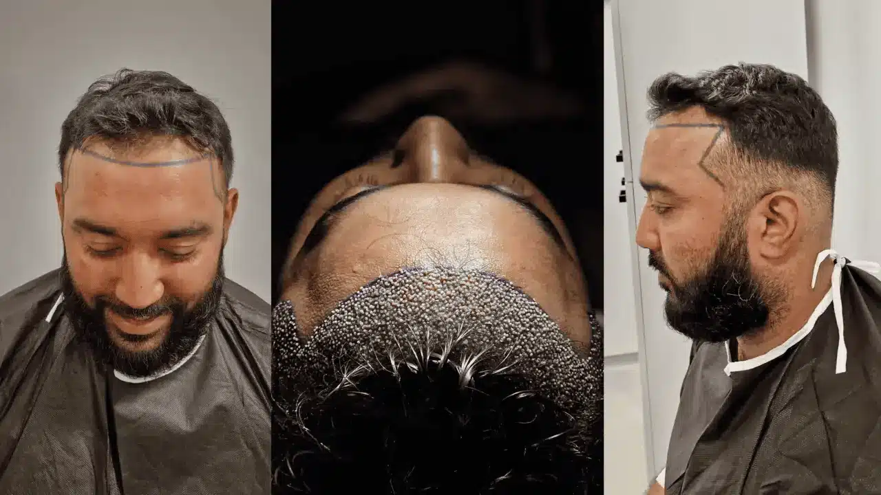 No Shave Hair Transplant Turkey