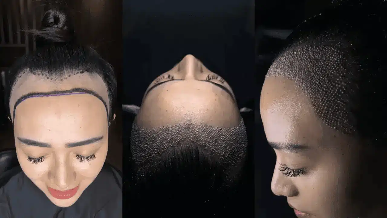 Female Hair Transplants No Shave