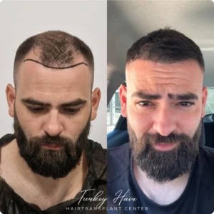 Before &Amp; After Hair Restoration Excellence You Can Trust