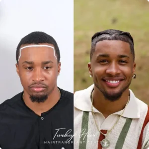 Before &Amp; After Hair Restoration Excellence You Can Trust
