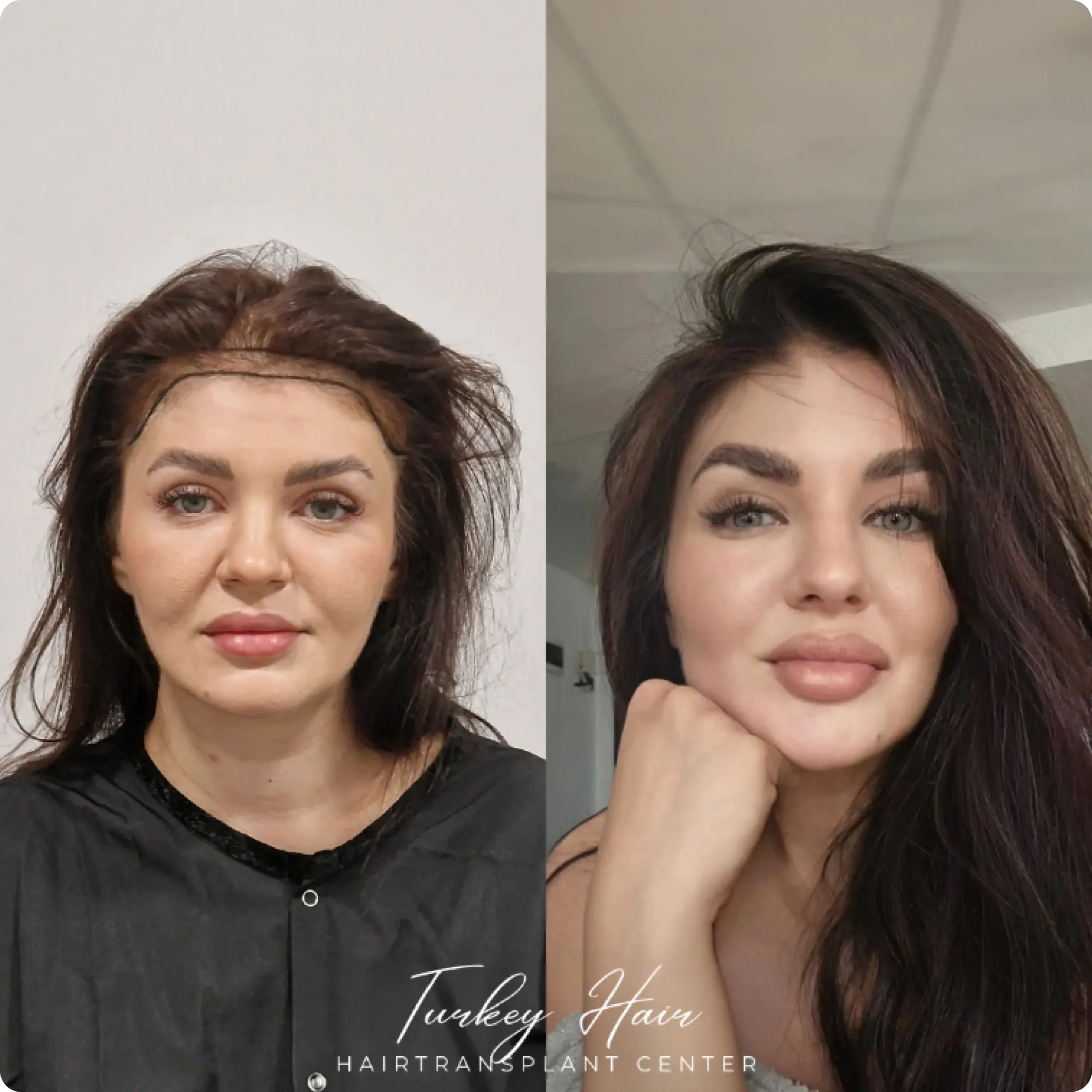 Hair Transplant Final Natural Result