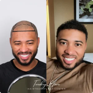 Before &Amp; After Hair Restoration Excellence You Can Trust