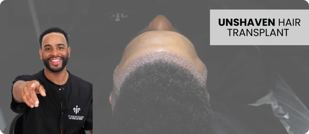 No Shave Hair Transplants