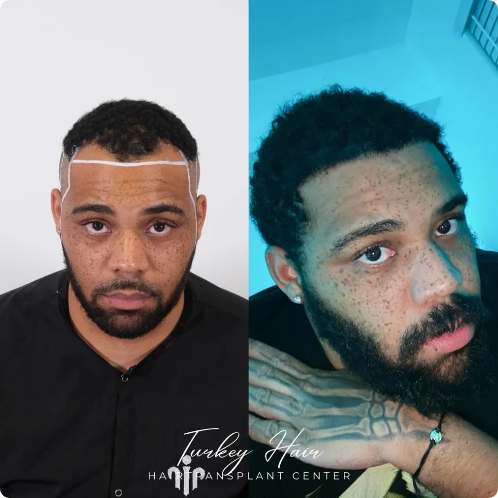 Afro Hair Transplant Before And After: 17 Real 12-Month Results &Amp; Expert Analysis Hair Restoration Excellence You Can Trust