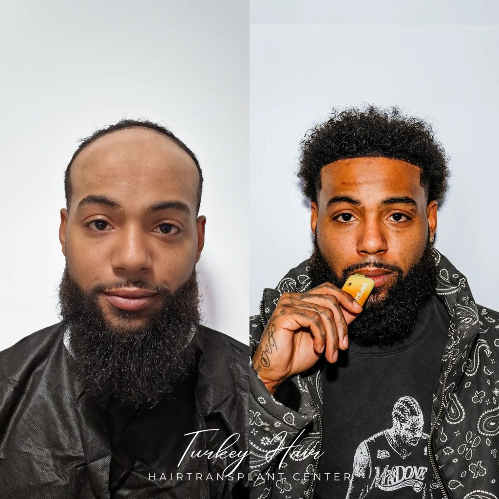 Afro Hair Transplant Before And After: 17 Real 12-Month Results &Amp; Expert Analysis Hair Restoration Excellence You Can Trust