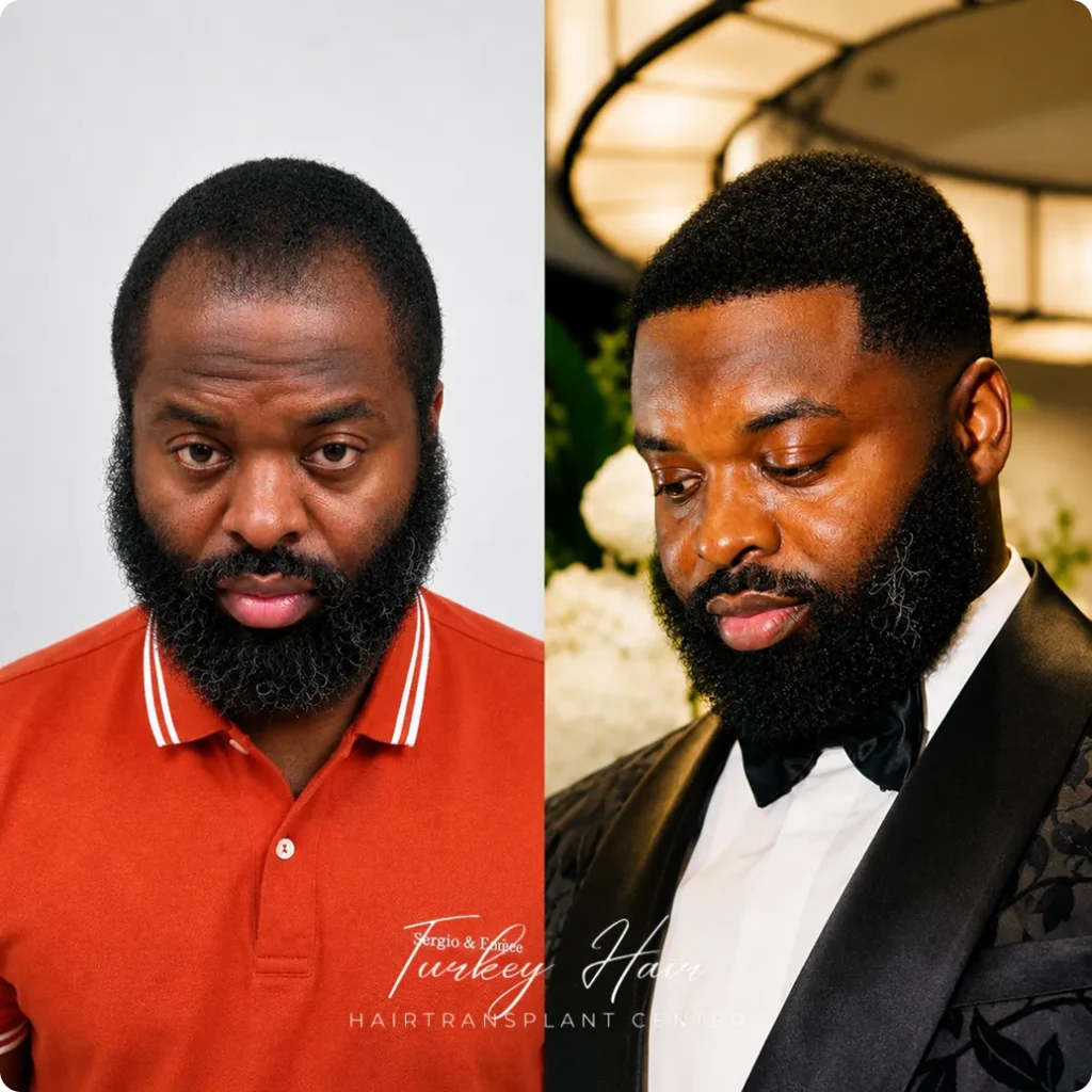 Afro Hair Transplant Before And After: 17 Real 12-Month Results &Amp; Expert Analysis Hair Restoration Excellence You Can Trust