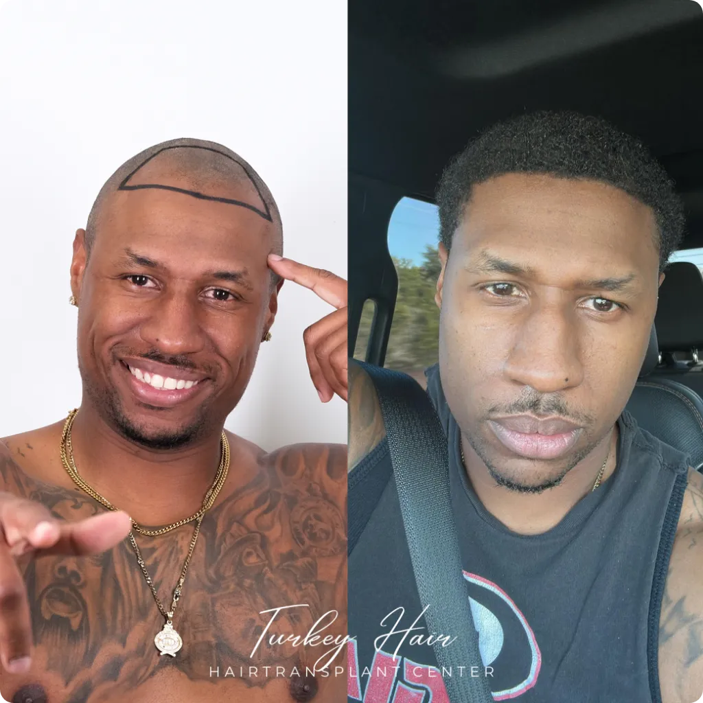 Afro Hair Transplant Before And After: 17 Real 12-Month Results &Amp; Expert Analysis Hair Restoration Excellence You Can Trust