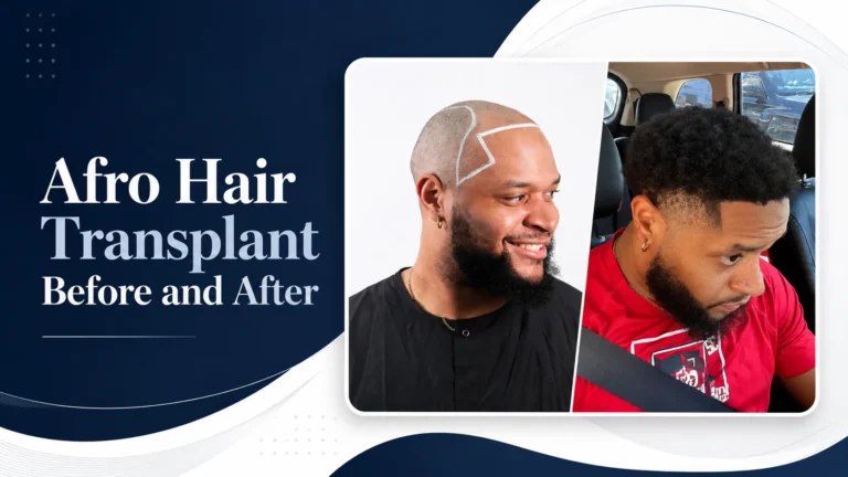 Afro Hair Transplant Before And After