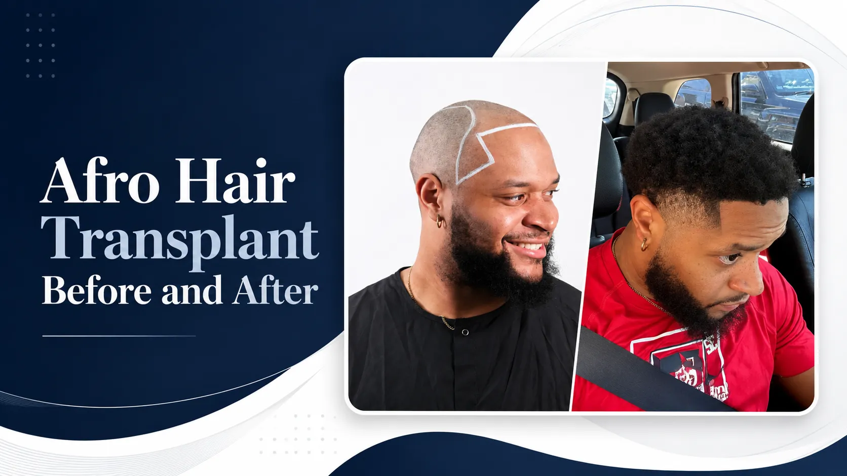 Afro Hair Transplant Before and After: 17 Real 12-Month Results & Expert Analysis