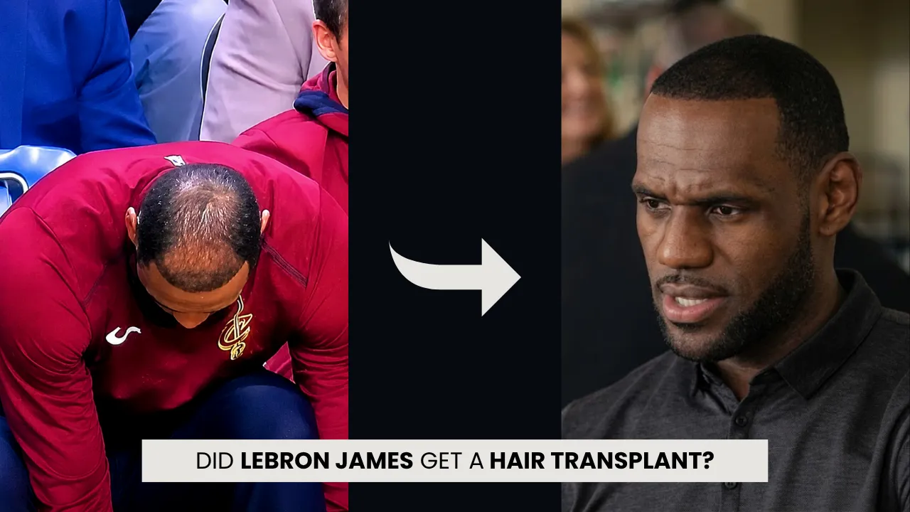 Lebron James Hair Transplant: Hairline Analysis 1 Lebron James Hair Transplant Before And After Hairline Comparison Showing Visible Thinning And Fuller Later Hairline