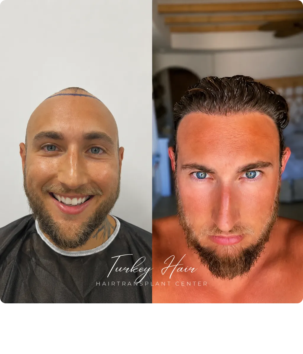Hair transplant before and after transformation showing natural hairline restoration and improved density