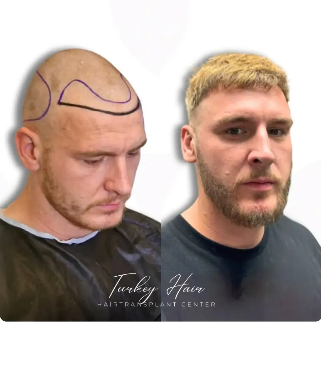 Hair transplant before and after result showing restored hairline and improved hair density in Turkey