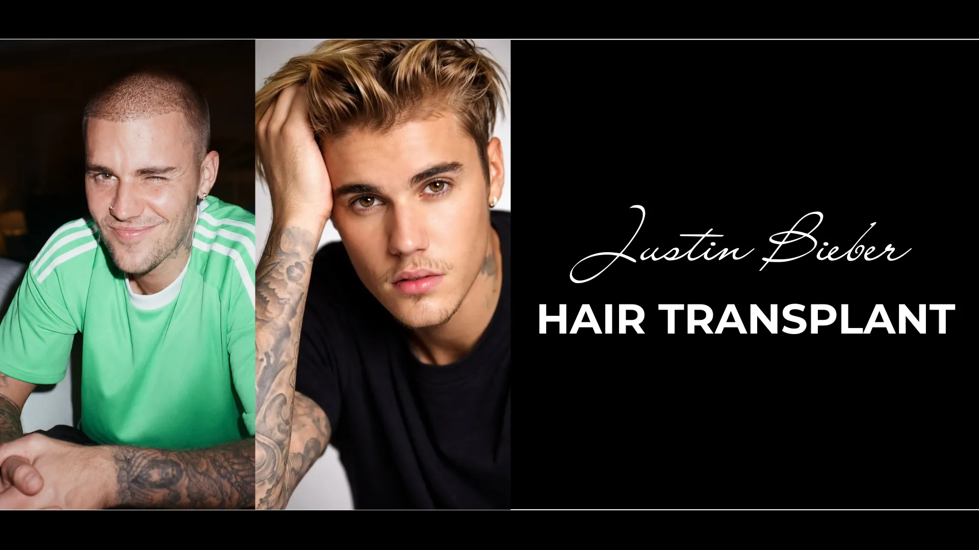 Justin Bieber Hair Transplant: Hairline Analysis, Before &Amp;Amp; After Photos, Rumors &Amp;Amp; Expert Opinion 1 Justin Bieber Hair Transplant Cover Image Showing Buzz Cut And Fuller Hairstyle Comparison For Hairline Analysis