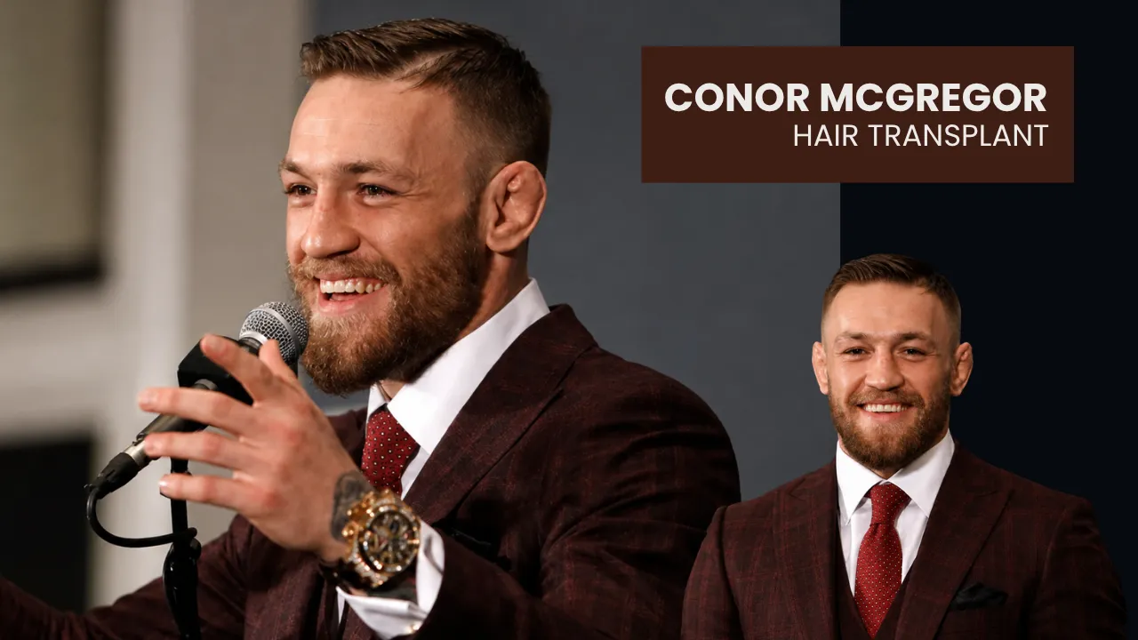 Conor Mcgregor Hair Transplant: Before &Amp;Amp; After 1 Conor Mcgregor Hair Transplant Before And After Hairline Restoration Analysis