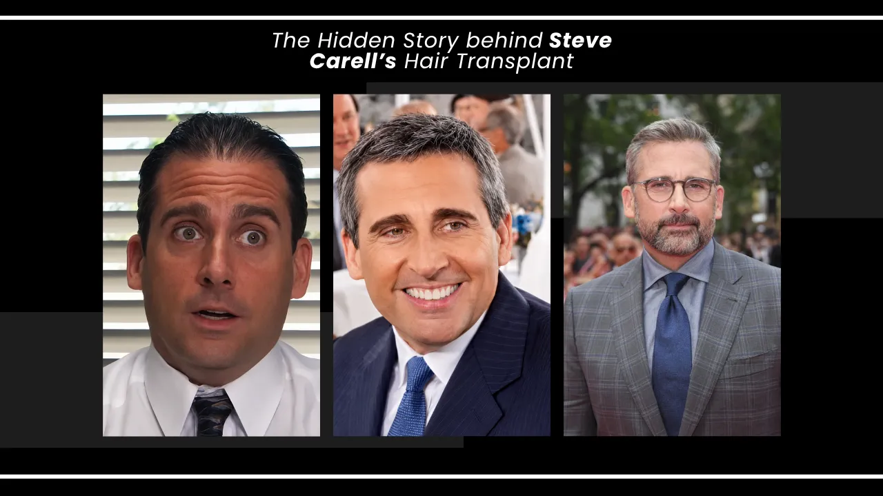 Steve Carell Hair Transplant Before And After Hairline Comparison Steve Carell Hair Transplant Before And After Hairline Comparison From The Office To Recent Years