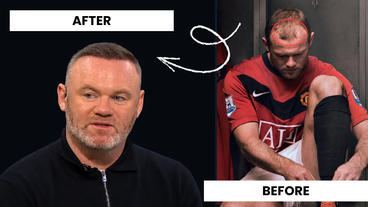 Wayne Rooney Hair Transplant: Before &Amp; After 6 Wayne Rooney Hair Transplant Before And After Comparison Showing Restored Hairline And Improved Density