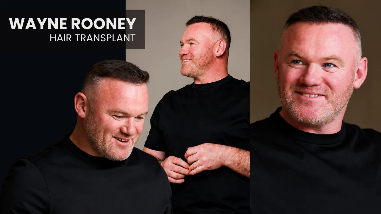 Wayne Rooney Hair Transplant: Before &Amp;Amp; After 1 Wayne Rooney Hair Transplant Before And After Results, Hair Restoration Journey And Long-Term Transformation