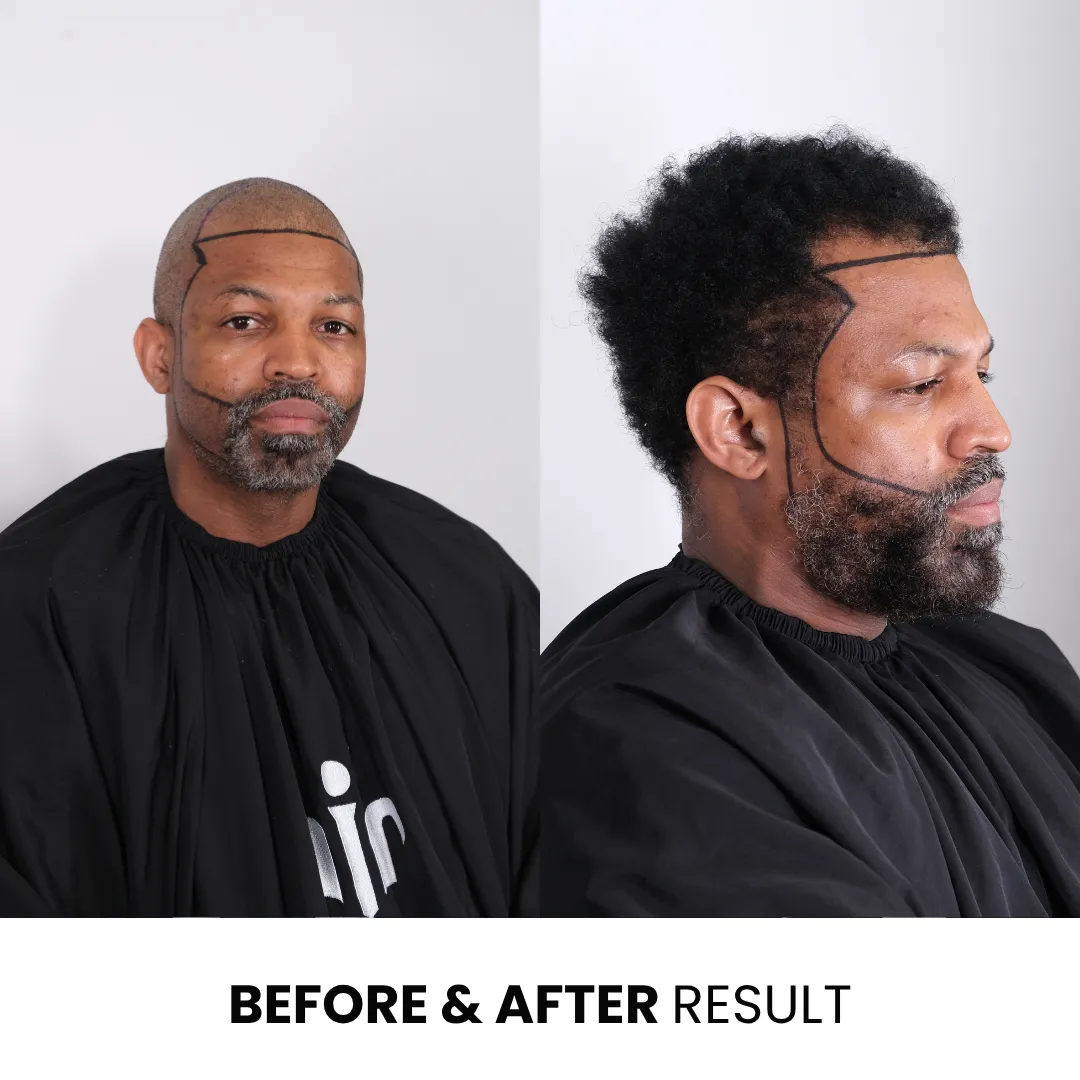 Afro Hair Transplant Before And After Result Showing Hairline Restoration And Treatment Planning