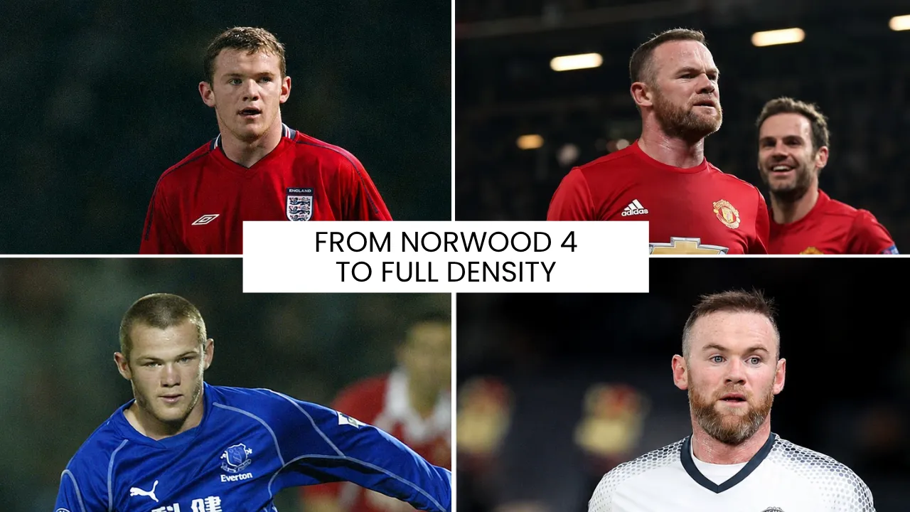 Wayne Rooney Hair Transplant: Before &Amp; After 3 Wayne Rooney Hair Transplant Transformation From Advanced Hair Loss To Improved Density And Restored Hairline