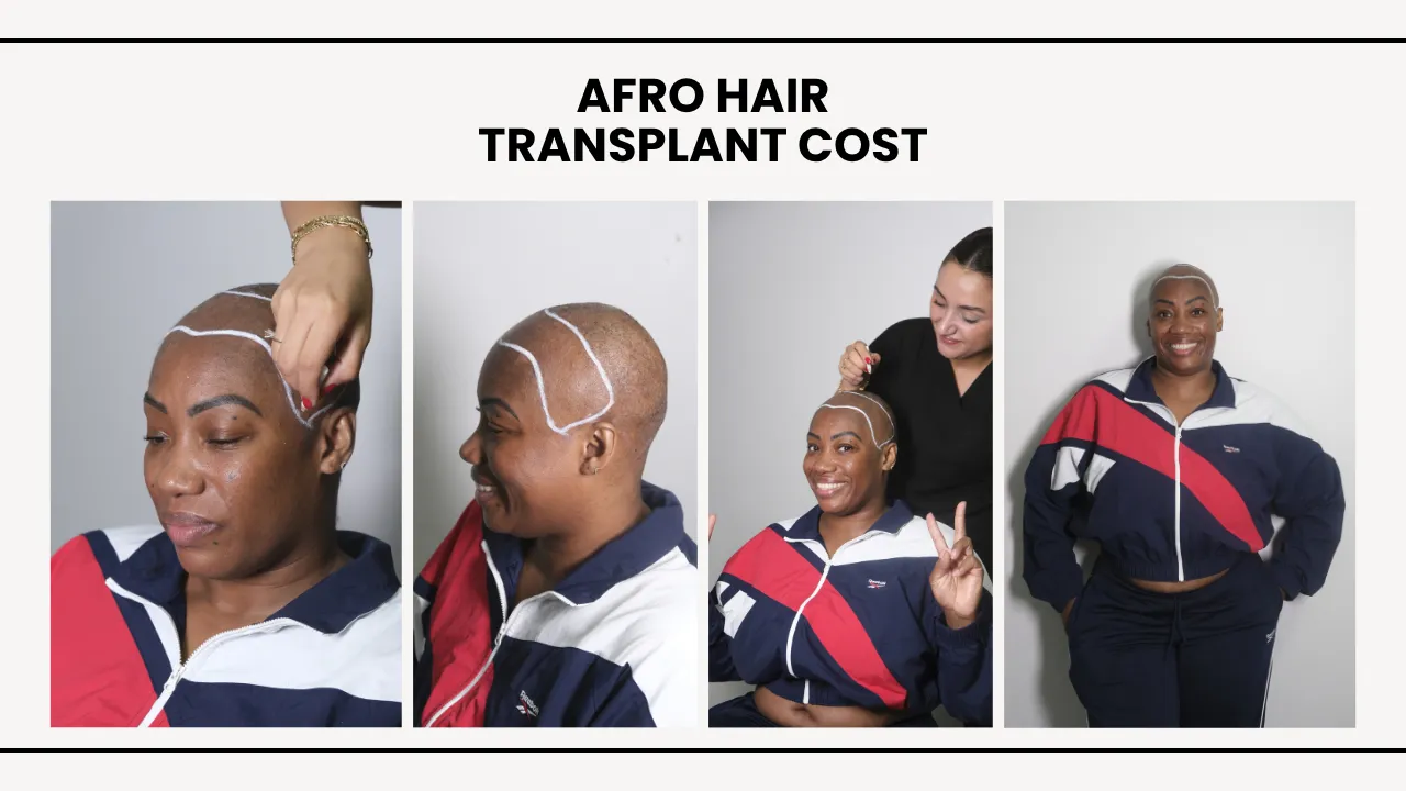 Afro Hair Transplant Cost In Turkey With Female Patient Consultation And Hairline Design