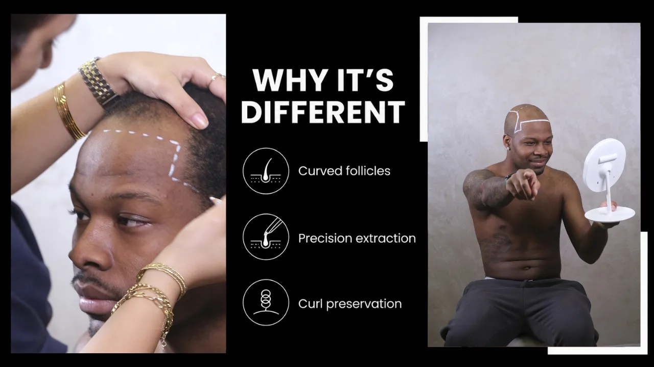 Afro Hair Transplant Procedure Showing Hairline Design And Curl-Preserving Technique